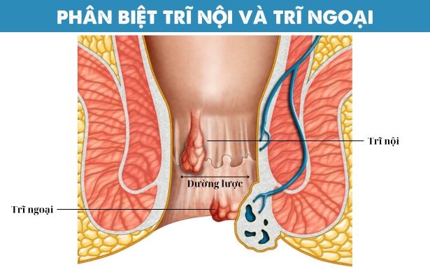 Cách phân biệt trĩ nội và trĩ ngoại: Bỏ túi bí quyết nhận biết chỉ trong 5 phút